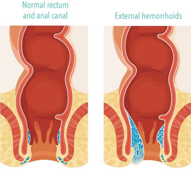 bpc 157 hemorrhoids BPC157 Dosing Recommendations by Weight main image 1